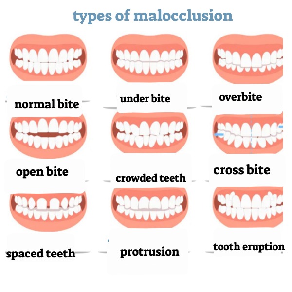 Types of Tooth Malocclusion