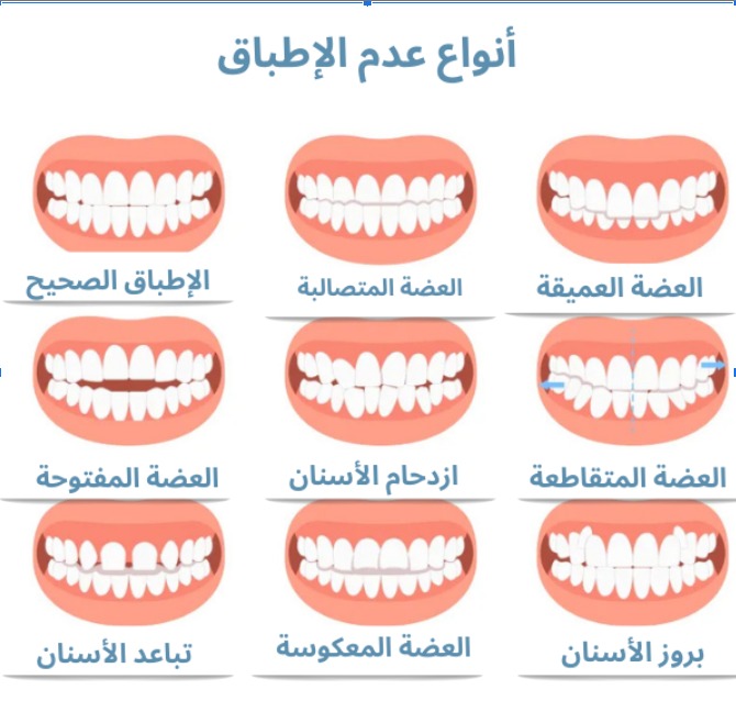 أنواع عدم تطابق الأسنان بشكل صحيح