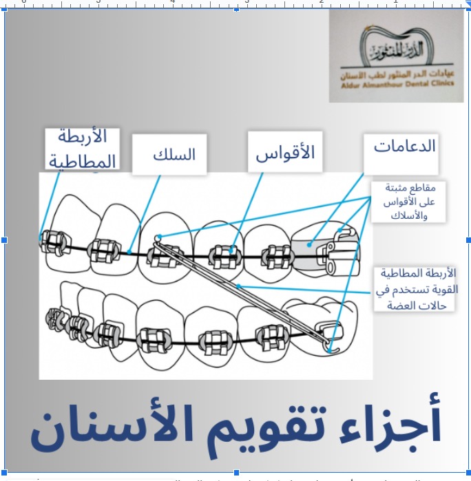 اجزاء تقويم الأسنان